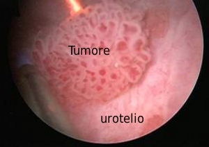 papilloma vescicale piatto