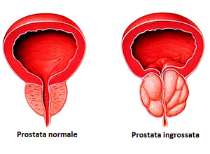 prostata ingrossata farmaco Népi jogorvoslatok a krónikus prosztatitishez