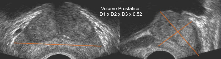 ecografie prostata valori normale kronični prostatitis prirodno liječenje